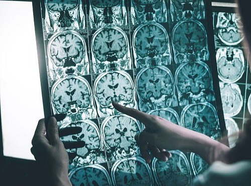 درمان جدیدی که میتواند به توقف آلزایمر کمک کند درمان الزایمر