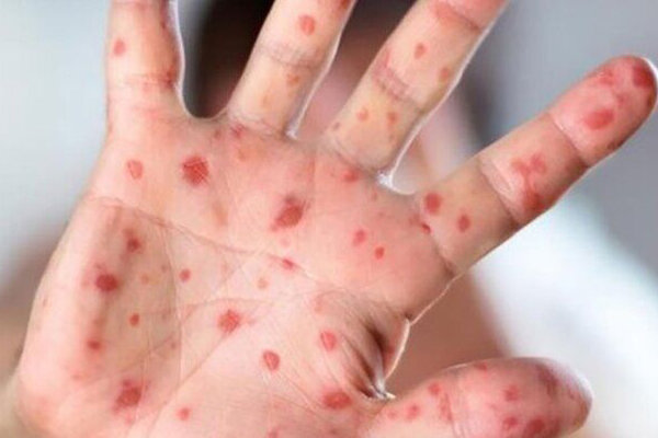 ابتلای ۹۶ نفر به سرخک در کشور / وزارت بهداشت: تزریق واکسن ضروری است