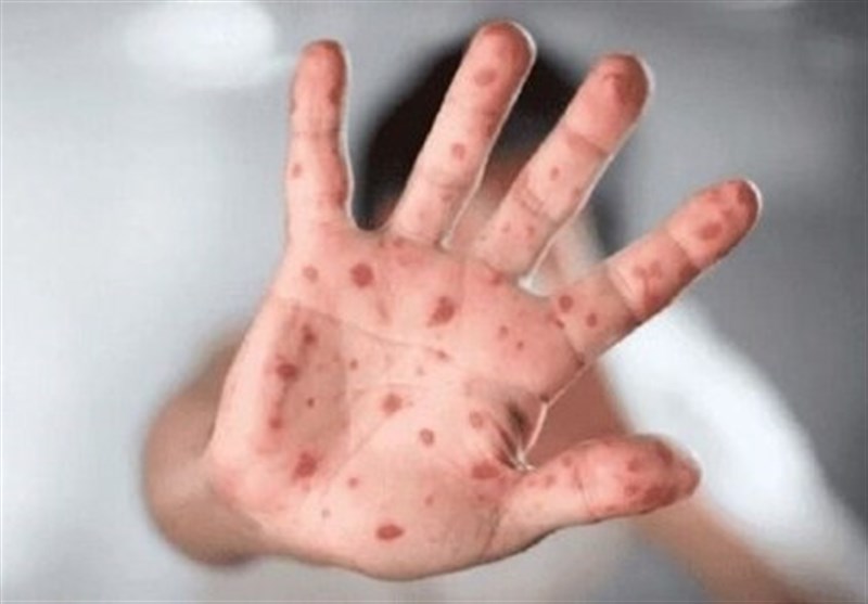 ثبت اولین مورد آبله میمونی در ترکیه ثبت اولین مورد آبله میمونی در ترکیه