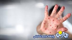 آبله میمونی، پشت درهای ایران آبله میمونی، پشت درهای ایران